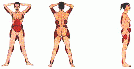 liposculpture01.gif liposculpture01.gif