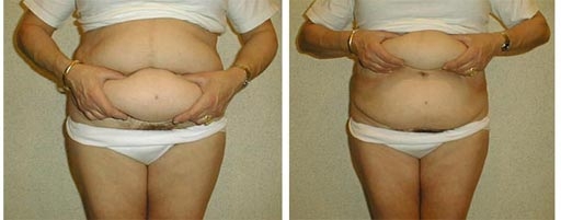 liposculpture03.jpg liposculpture03.jpg