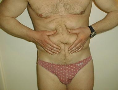 liposculpture04.jpg liposculpture04.jpg