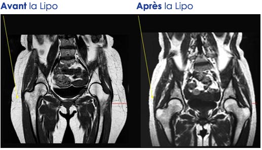 liposculpture05.jpg