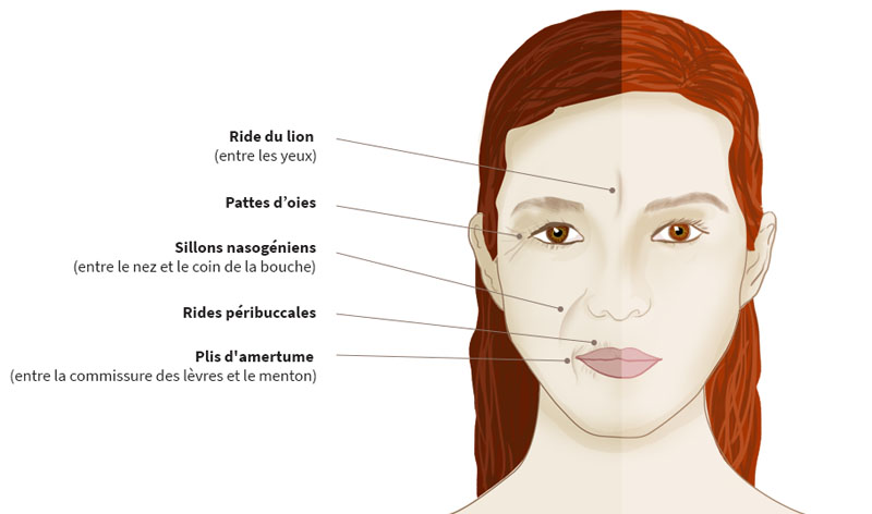 Schéma des zones d'injection de l'acide hyaluronique sur le visage