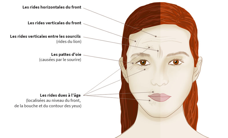 Schéma des zones d'injection du Botox sur le visage